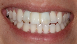 Temporary Resin Bridge on Implants